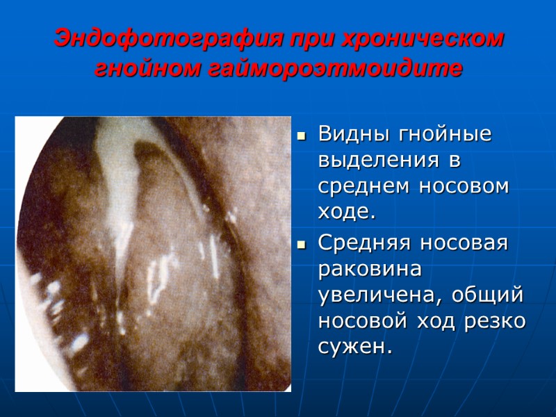 Эндофотография при хроническом гнойном гаймороэтмоидите Видны гнойные выделения в среднем носовом ходе. Средняя носовая